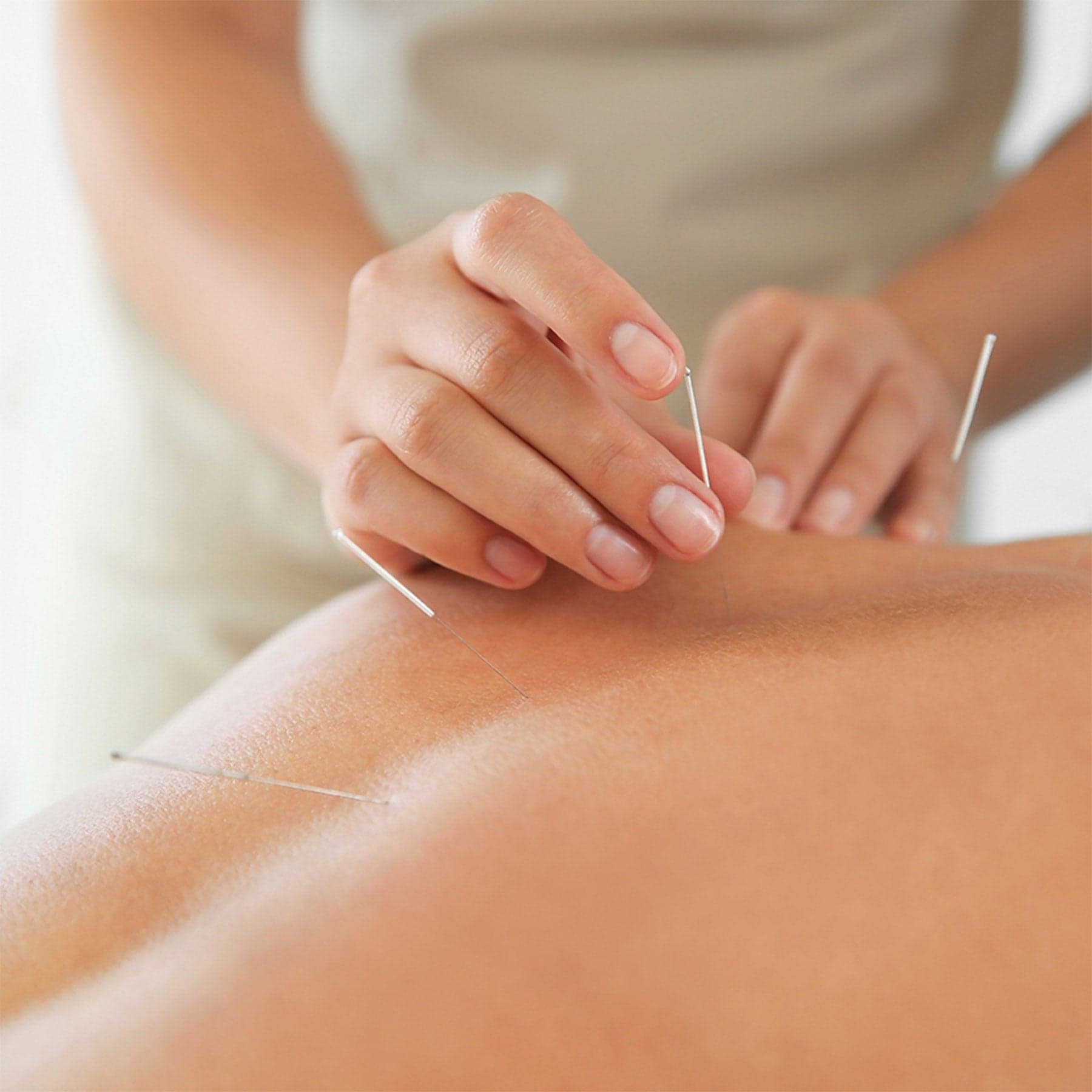 Séance d'acupuncture